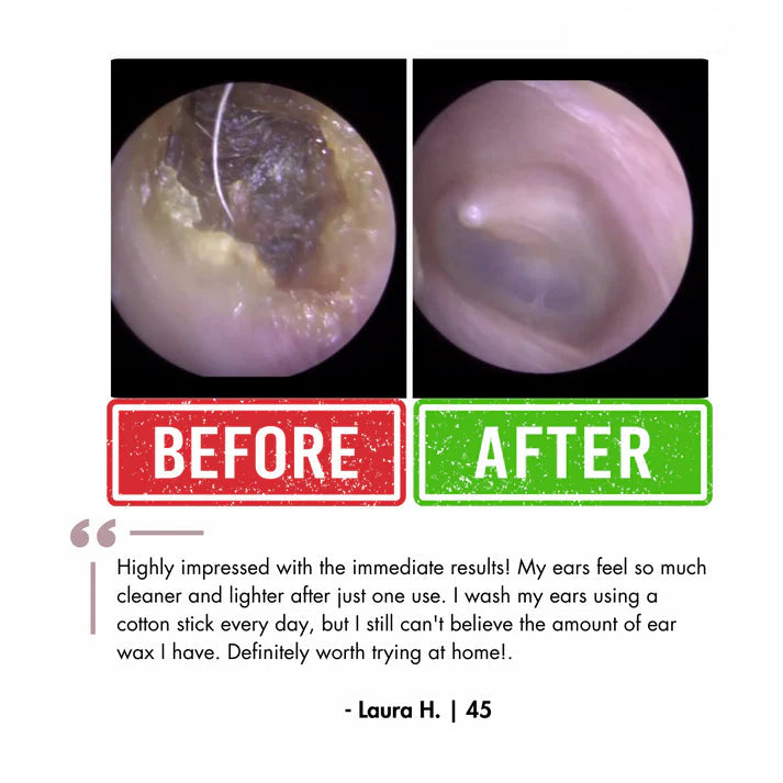 Orzyum™ Electric Earwax cleaner